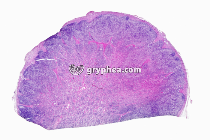 Ganglion lymphatique CT x1,5 - gryphea.com